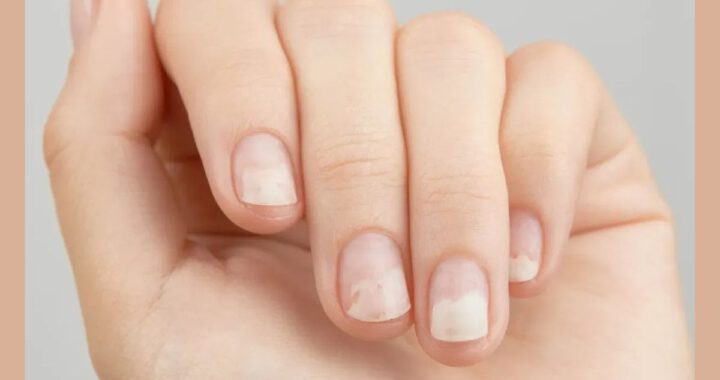 Understanding Gingerbread Nails Disease: Symptoms, Causes, and Effective Ways to Manage It
