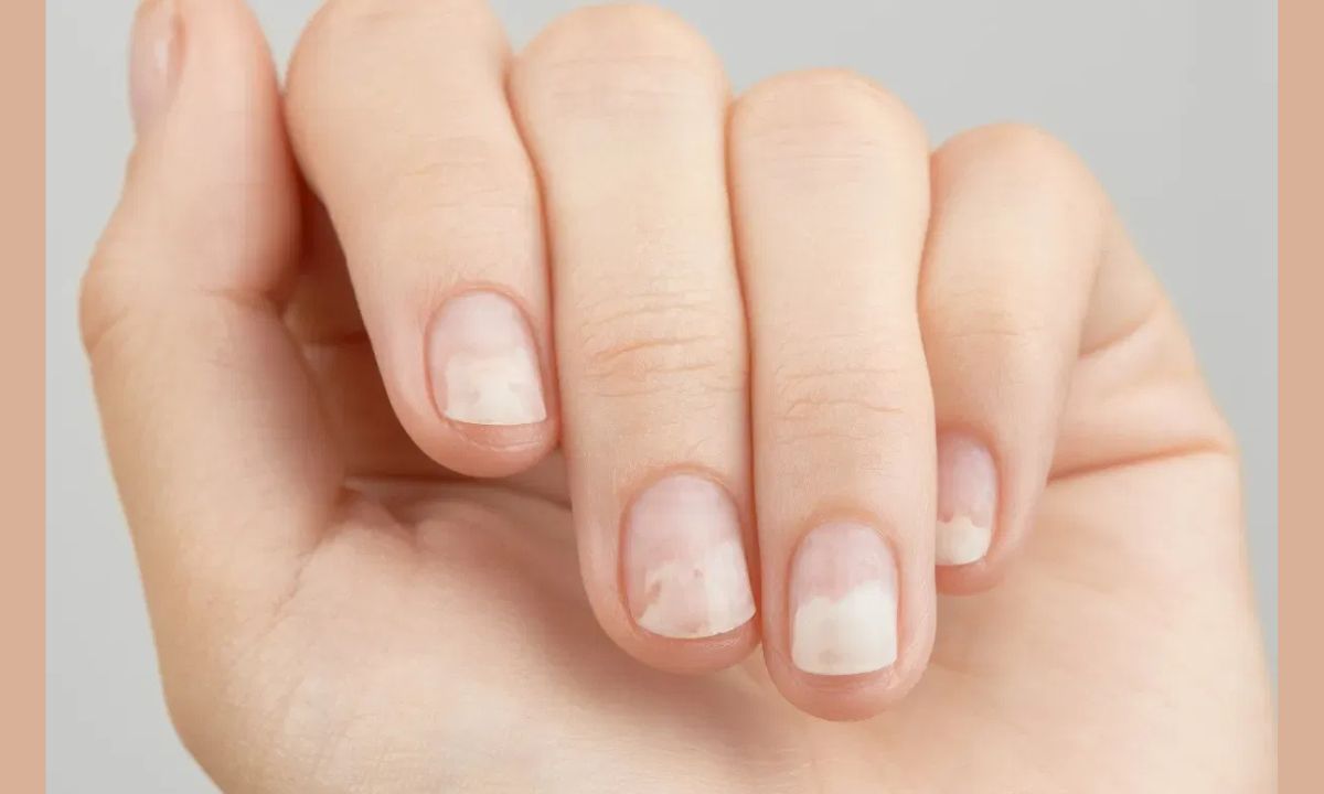 gingerbread nails disease